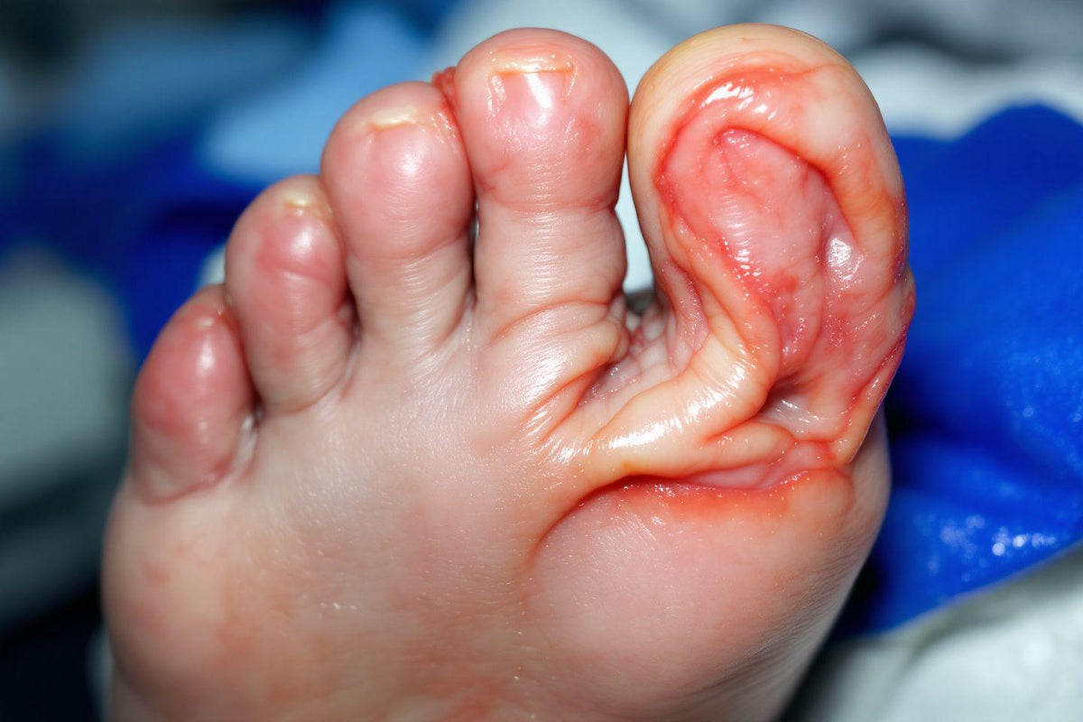 Orteil gonflé, rouge et douloureux : causes, symptômes et photos pour identifier le problème